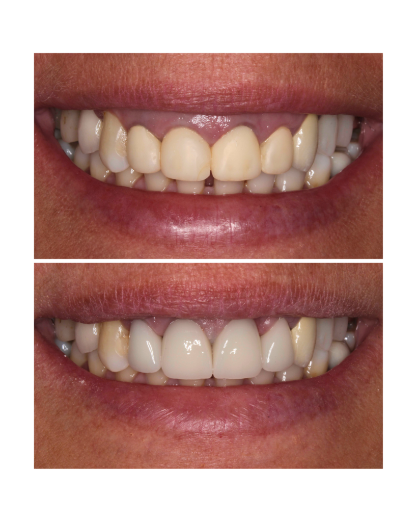 gengivoplastia e coroas em porcelana