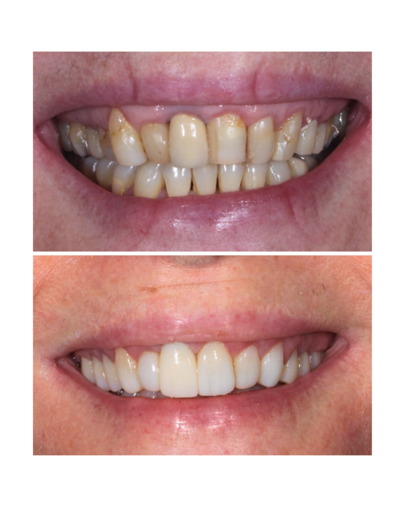 Coroas em porcelana, facetas e gengivoplastia