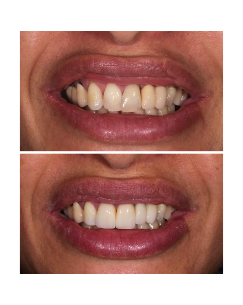 Facetas em resina e clareamento