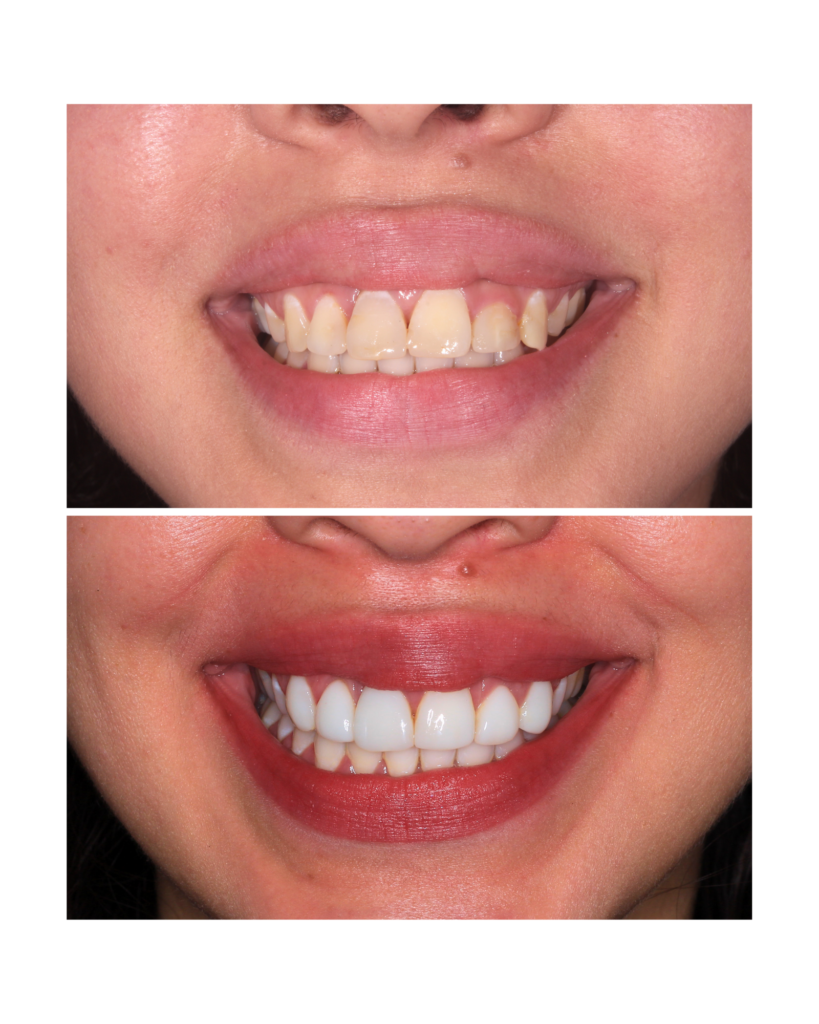 Facetas em resina e clareamento