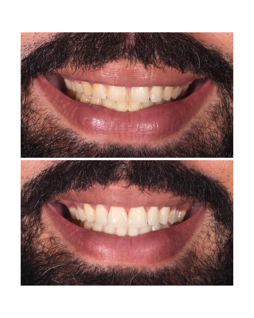 Facetas em resina e clareamento